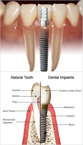 South Muskoka Dental Group dental implants