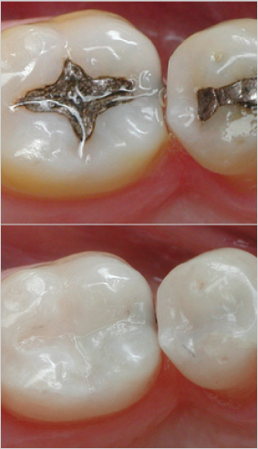 South Muskoka Dental Group teeth fillings