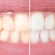 South Muskoka Dental Group teeth whitening